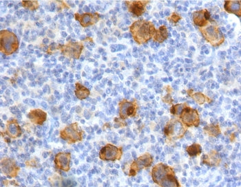 IHC testing of FFPE human Hodgkin's lymphoma with recombinant CD30 antibody (clone CDLA30-2R). Requi