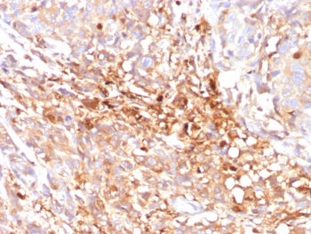 IHC staining of FFPE triple negative breast cancer tissue with MRP8 antibody (clone ABCC11/2438). HI