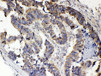 IHC testing of FFPE human intestinal cancer tissue with RANK antibody at 1ug/ml. Required HIER: stea
