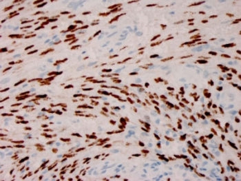 IHC staining of FFPE Kaposiâ€™s sarcoma with Herpes Virus 8 antibody (clone HHV8/3606). HIER: boil t
