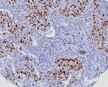 IHC staining of FFPE human lung adenocarcinoma. Ki67 antibody (clone MKI67/8005R). HIER: boil tissue