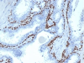 IHC staining of FFPE human prostate cancer with recombinant p63 antibody (clone TP63/4379R). HIER: b