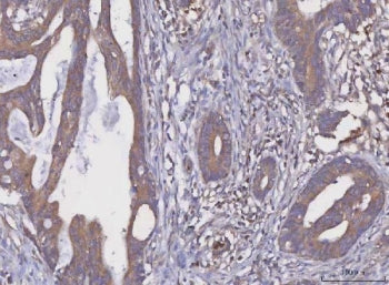 IHC staining of FFPE human rectal cancer tissue with MGAT2 antibody. HIER: boil tissue sections in p