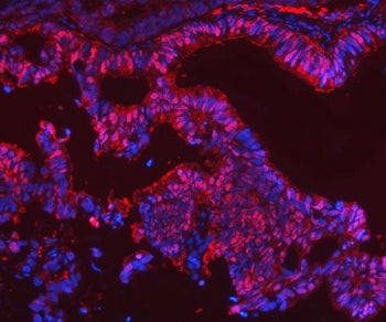 Immunofluorescent staining of FFPE human rectal cancer tissue with Selenium Binding Protein antibody