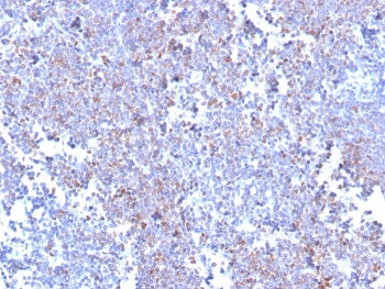 IHC staining of FFPE human mantle cell lymphoma with recombinant SOX11 antibody (clone SOX11/3235R).