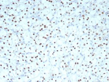IHC staining of FFPE human renal cell carcinoma tissue with PAX2 antibody (clone PAX2/8671R) at 2ug/