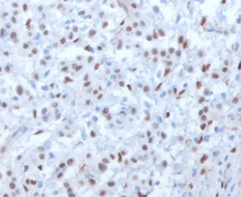 IHC testing of FFPE human mesothelioma with WT1 antibody (clone WLMT1-1). Required HIER: boil tissue