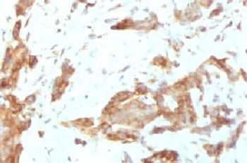 IHC testing of FFPE human breast carcinoma with GRP94 antibody (clone SRPR90b). FFPE testing require