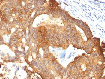 IHC: Formalin-fixed, paraffin-embedded colon carcinoma stained with Cytokeratin 8 antibody (clone B2