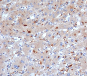 IHC staining of FFPE human liver tissue with SERPINA3 antibody (clone SERPINA3/4190). HIER: boil tis