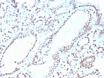 IHC staining of FFPE human thyroid with recombinant PAX8 antibody. HIER: boil tissue sections in pH 