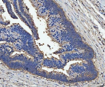 IHC staining of FFPE human colorectal adenocarcinoma tissue with Lactadherin antibody. HIER: boil ti