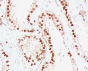 IHC staining of FFPE human colon carcinoma with RAD51 antibody (clone RALPA-1). HIER: boil tissue se