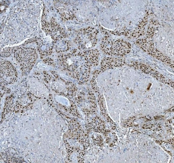 IHC staining of FFPE human lung cancer tissue with TRMT6 antibody. HIER: boil tissue sections in pH8