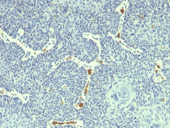 IHC staining of FFPE human cervix with HPV18 E6 antibody (clone HPV18/1297). HIER: boil tissue secti