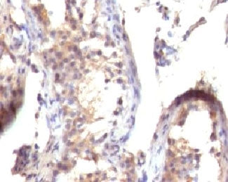 IHC testing of FFPE human testicular carcinoma with TGF alpha antibody (clone TFGFa-1). FFPE testing