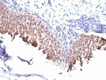 IHC: Formalin-fixed, paraffin-embedded human bladder carcinoma stained with Cytokeratin 10 antibody 