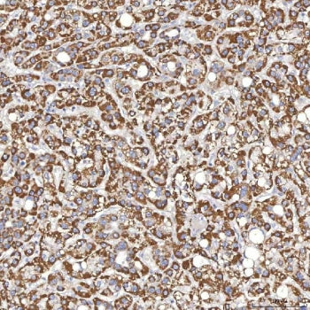 IHC staining of FFPE human liver cancer tissue with Thyroxine Binding Globulin antibody. HIER: boil 