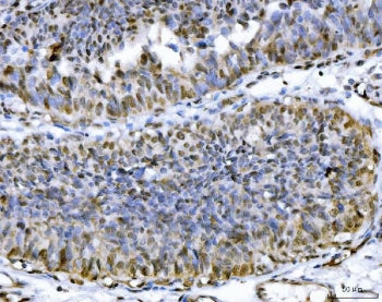 IHC testing of FFPE human colon cancer tissue with ATP Citrate Lyase antibody at 2ug/ml. HIER: steam