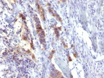 IHC: Formalin-fixed, paraffin-embedded human gastric carcinoma stained with MUC5-AC antibody (SPM488