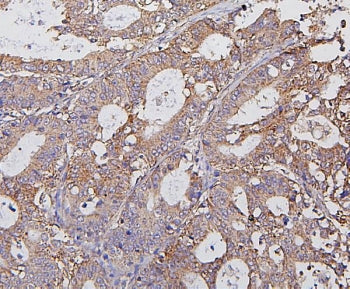 IHC staining of FFPE human rectal cancer with Hexokinase 1 antibody. HIER: boil tissue sections in p