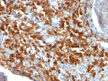 IHC staining of FFPE human lymphoma with CD79a antibody (clone IGA/515). HIER: formalin-fixed tissue