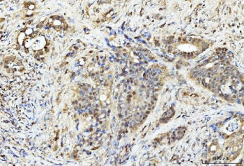 IHC staining of FFPE human gall bladder adenosquamous carcinoma tissue with PDCD4 antibody. HIER: bo