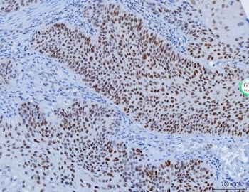 IHC staining of FFPE human laryngeal squamous cell carcinoma tissue with YY1 antibody. HIER: boil ti