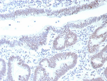 IHC staining of FFPE human colon carcinoma tissue with recombinant TP53 antibody (clone rTP53/8993).
