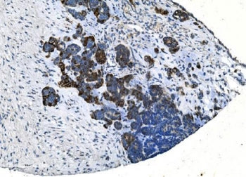 IHC staining of FFPE human ovarian cancer with TMPRSS3 antibody. HIER: boil tissue sections in pH8 E