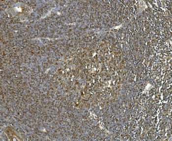 IHC staining of FFPE metastatic human rectal cancer in lymph node with HSPA8 antibody. HIER: boil ti