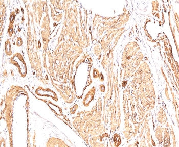 IHC: FFPE human leiomyosarcoma stained with Smooth Muscle Actin antibody (clone 1A4).