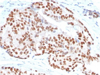 IHC staining of FFPE human prostate carcinoma with NKX3.1 antibody. HIER: boil tissue sections in pH