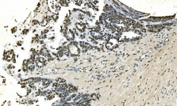 IHC staining of FFPE human ovarian cancer with LSM7 antibody. HIER: boil tissue sections in pH8 EDTA