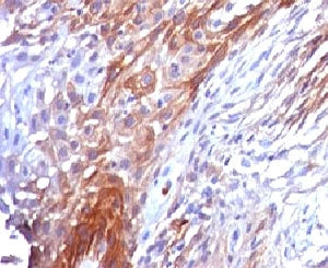 IHC testing of FFPE cervical carcinoma and Cytokeratin 17 antibody (clone CTKN17-1). FFPE testing re