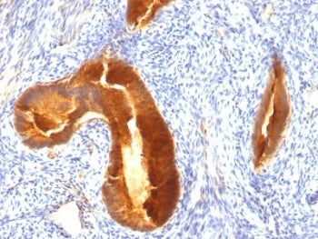 IHC staining of FFPE human endometrial carcinoma with MUC-1 antibody. HIER: boil tissue sections in 