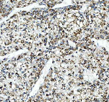 Immunohistochemical staining of FFPE human liver cancer tissue with ALDH2 antibody, HRP-secondary and DAB substrate. HIER: boil tissue sections in pH8 EDTA for 20 min and allow to cool before testing.