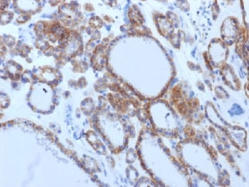 IHC testing of FFPE human thyroid carcinoma with TSHR antibody (clone TSHRB/1405). Required HIER: bo