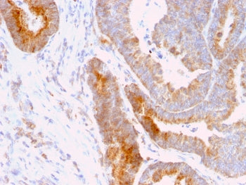 IHC staining of FFPE human colon carcinoma with Thomsen-Friedenreich Antigen antibody (clone A84-A/F