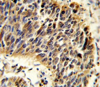IHC testing of FFPE human lung carcinoma tissue with Vitronectin antibody. HIER: steam section in pH
