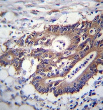 IHC testing of FFPE human colon carcinoma tissue with Cytokeratin 12 antibody. HIER: steam section i