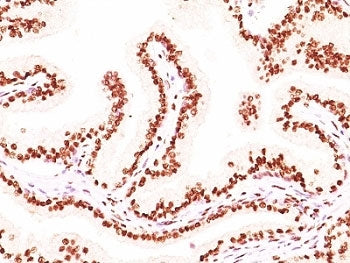 IHC: Formalin-fixed, paraffin-embedded human prostate carcinoma stained with Androgen Receptor antib