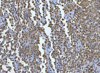 IHC staining of FFPE human testicular germ cell tumor tissue with TCF-8 antibody. HIER: boil tissue 