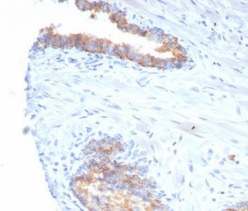 IHC staining of FFPE human prostate carcinoma tissue with CD38 antibody (clone rCD38/6982) at 2ug/ml
