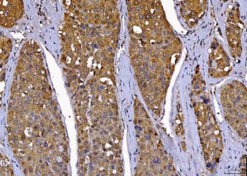 IHC staining of FFPE human liver cancer tissue with Cdc2 related protein kinase 2 antibody. HIER: bo