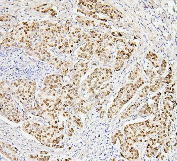 IHC staining of FFPE human breast cancer with Histone H1.0 antibody. HIER: boil tissue sections in p