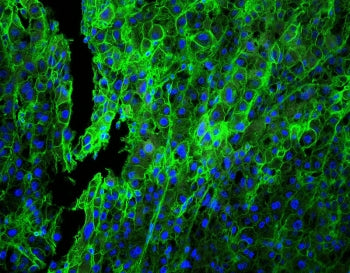 Immunofluorescent staining of FFPE human lung cancer with HLA-C antibody (green) at 1ug/ml and DAPI 