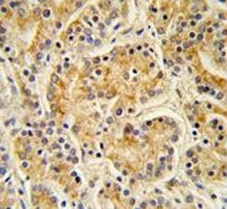 IHC testing of FFPE human prostate carcinoma tissue with MOB kinase activator 1A antibody. HIER: ste