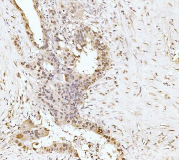 IHC staining of FFPE human appendiceal adenocarcinoma tissue with RRP4 antibody. HIER: boil tissue s