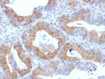 IHC testing of FFPE human ovarian carcinoma with LHR antibody (clone LHCGR/1417). Required HIER: boi